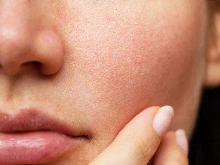 Tomato and Lemon Juice Face Pack for Pore Minimizing