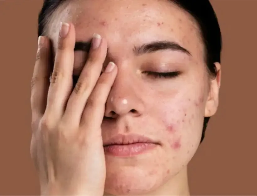 Milk and Urad Dal Facial for Dark Spots