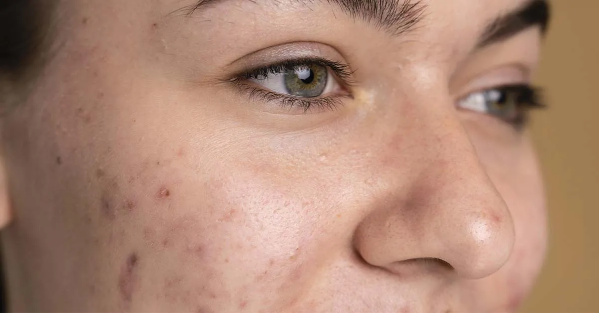 Benefits of Milk and Urad Dal for Skin