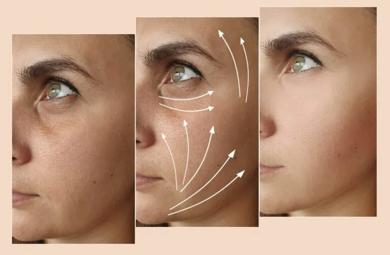 Sculptra