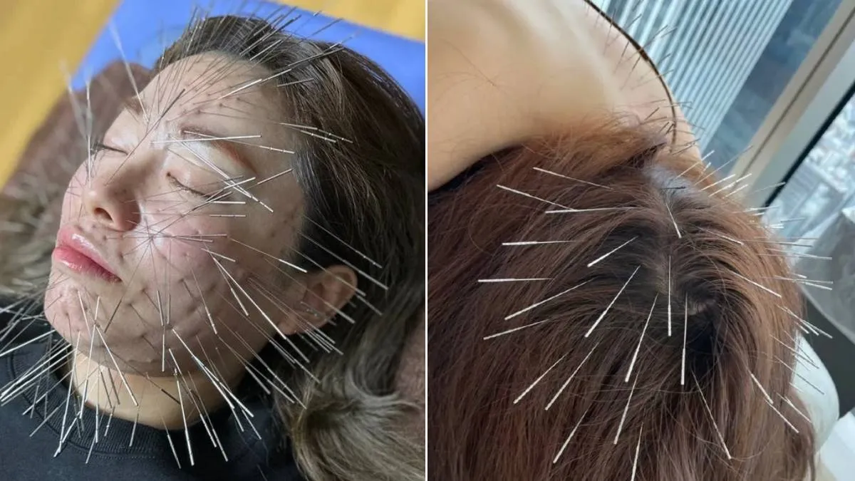 Shirakawa Acupuncture Craze 2025