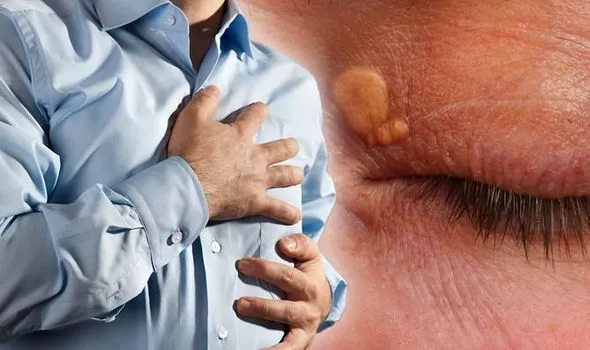 High cholesterol symptoms to watch for