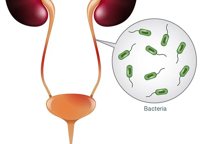 UTI foods to avoid during treatment