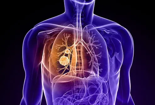 Lung cancer myths and facts 2025