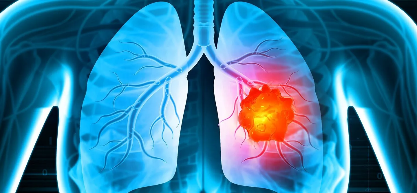Lung cancer in young adults 2025