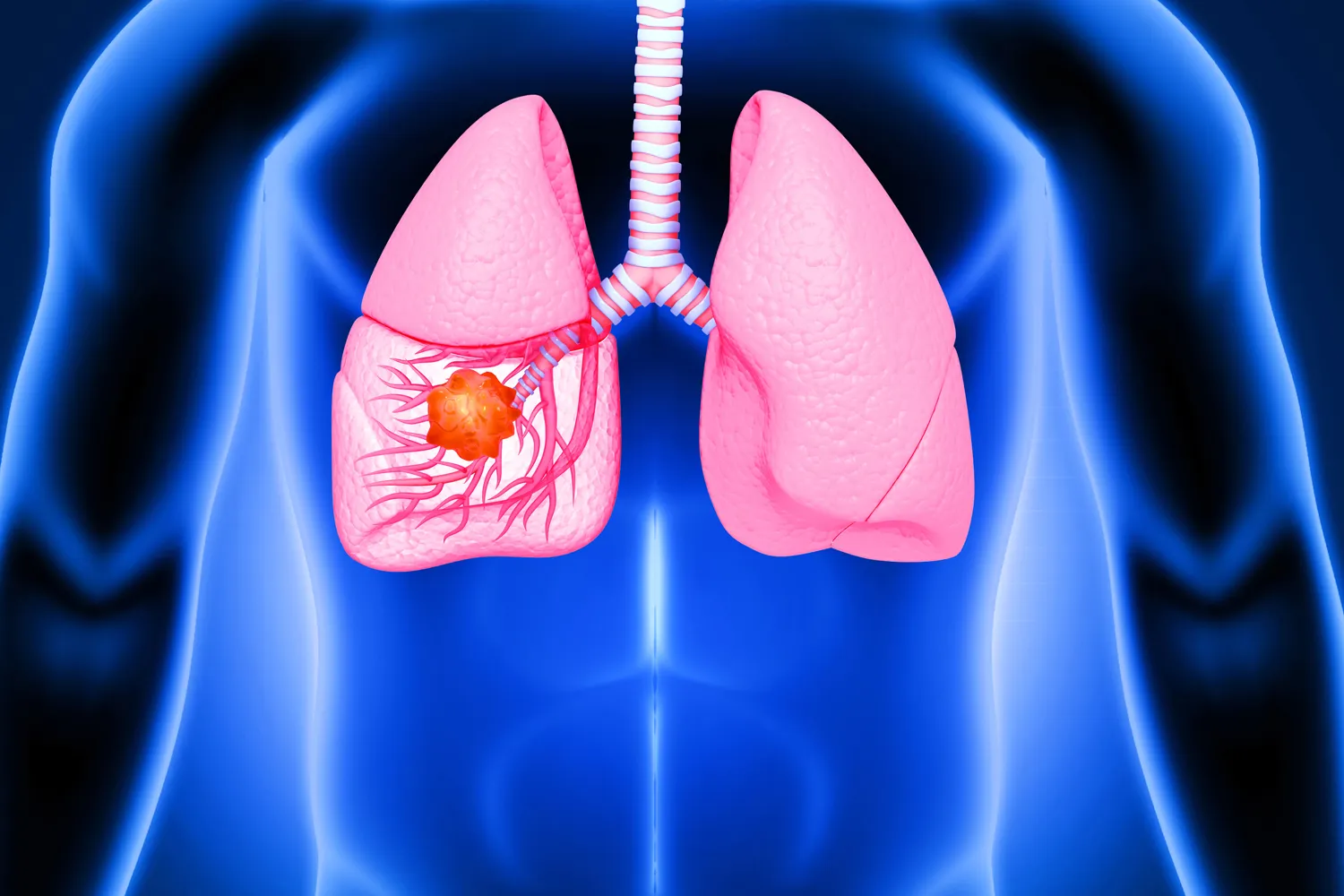 Lung cancer in women 2025