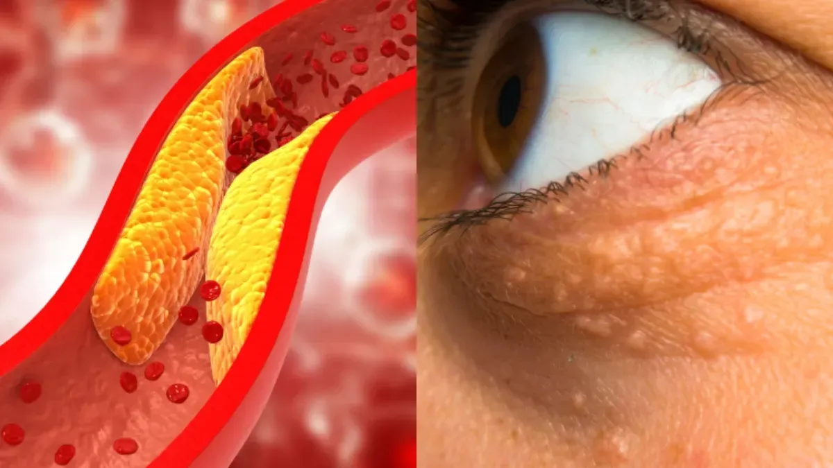 High Cholesterol Symptoms