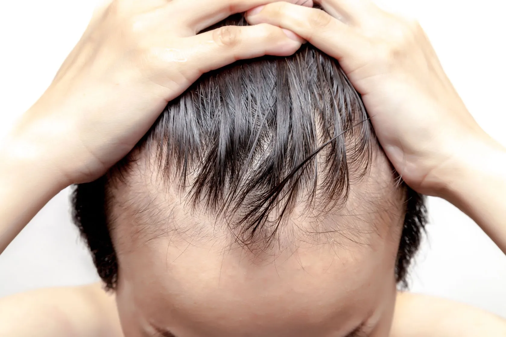 Baldness Patterns in Men and Women