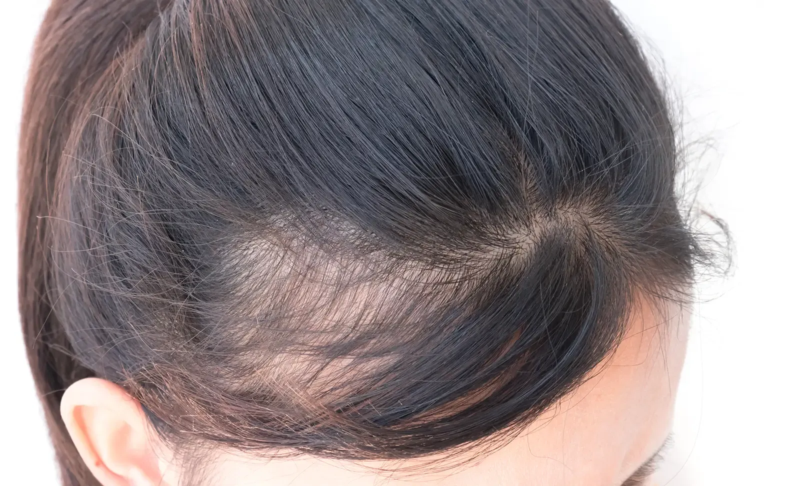 Hormonal Effects on Baldness
