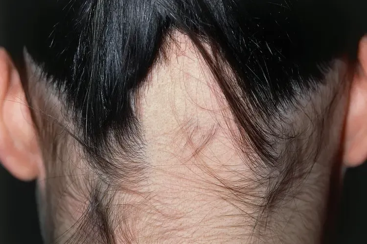Baldness Progression Men vs Women