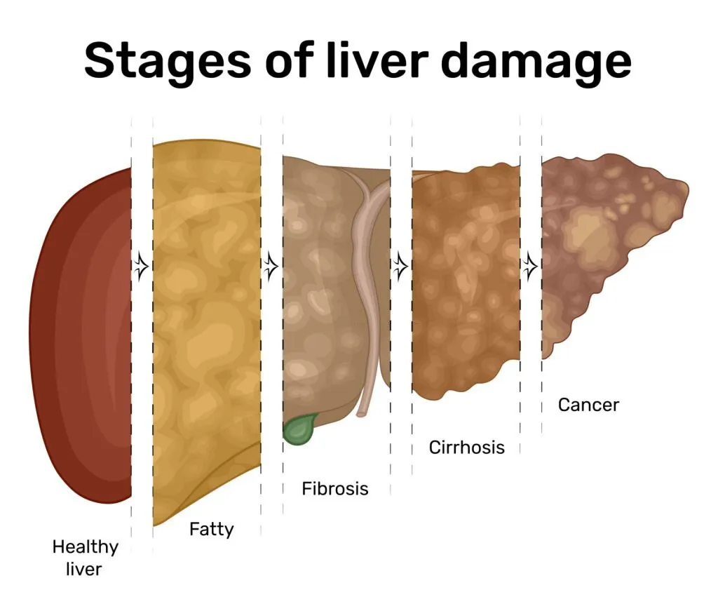 Fatty liver treatment Dr. Chokkalingam natural reversal