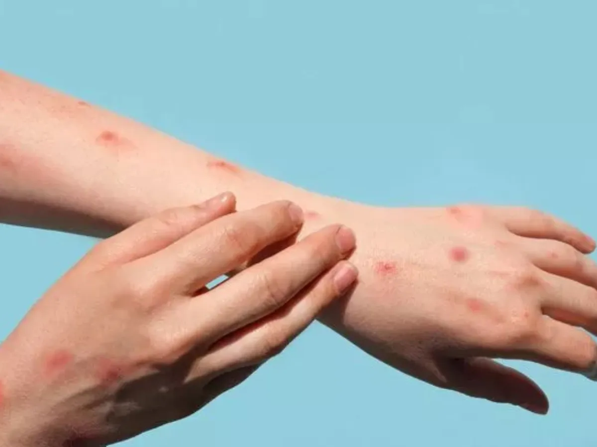 symp-mpox