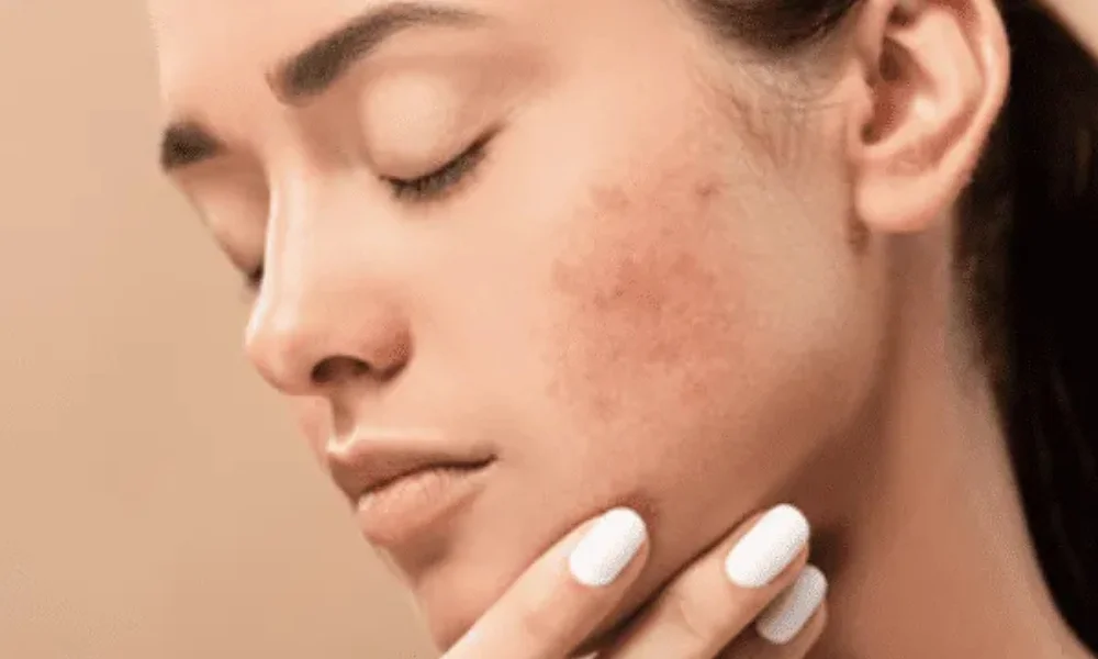 How to Get Clear Skin Naturally Home Remedies That Actually Work