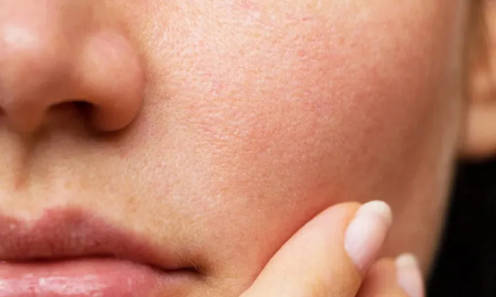 Tomato and Lemon Juice Face Pack for Pore Minimizing