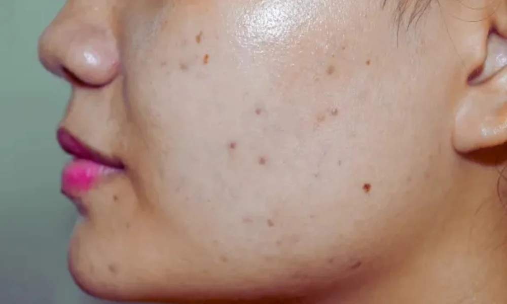 Facial for Glowing Skin and Dark Spot Removal