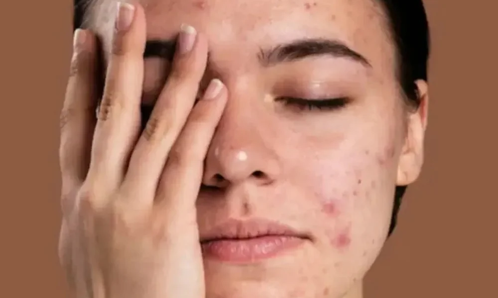 Milk and Urad Dal Facial for Dark Spots