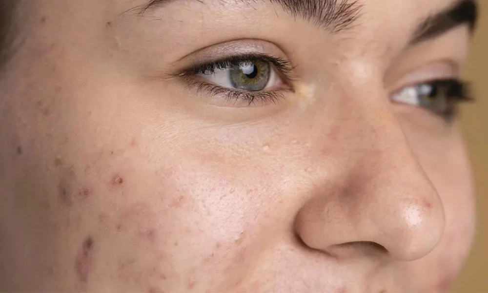 Benefits of Milk and Urad Dal for Skin