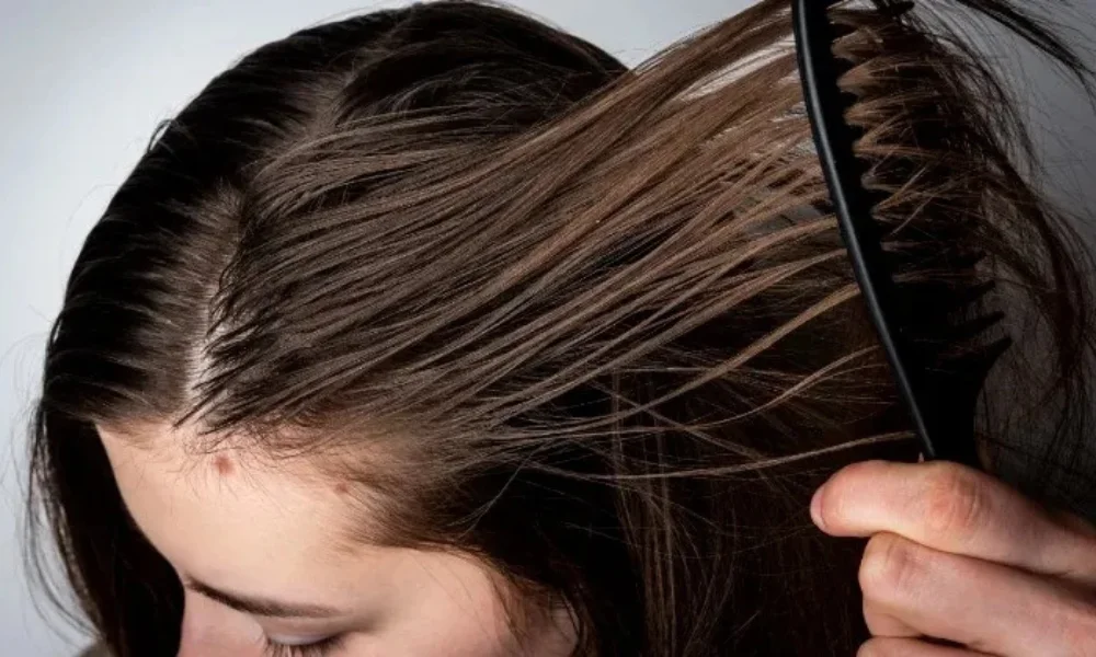 Oily Dandruff Fixes