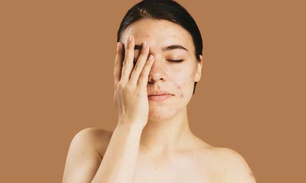 Skincare Routine for Combination Oily Skin in Humid Indian Cities
