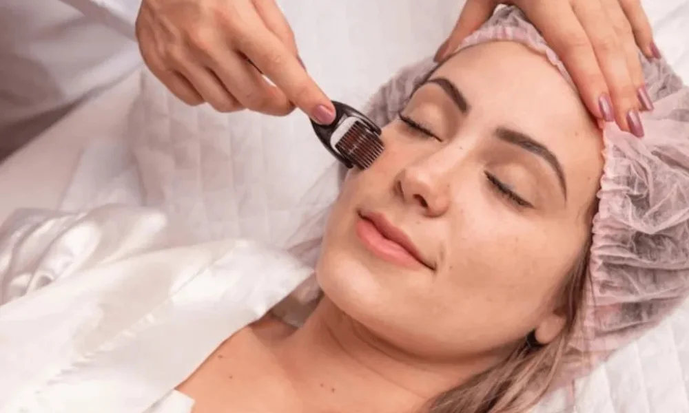 microneedling treatment process