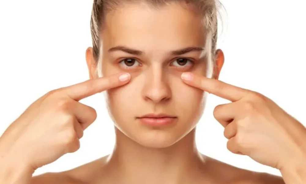 how to remove dark circles naturally