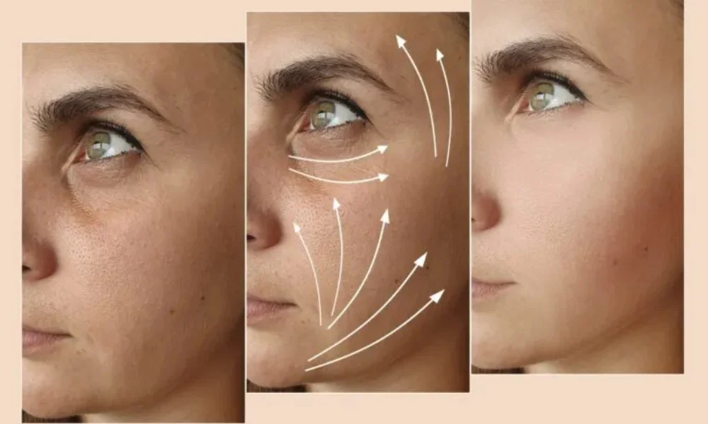 Sculptra