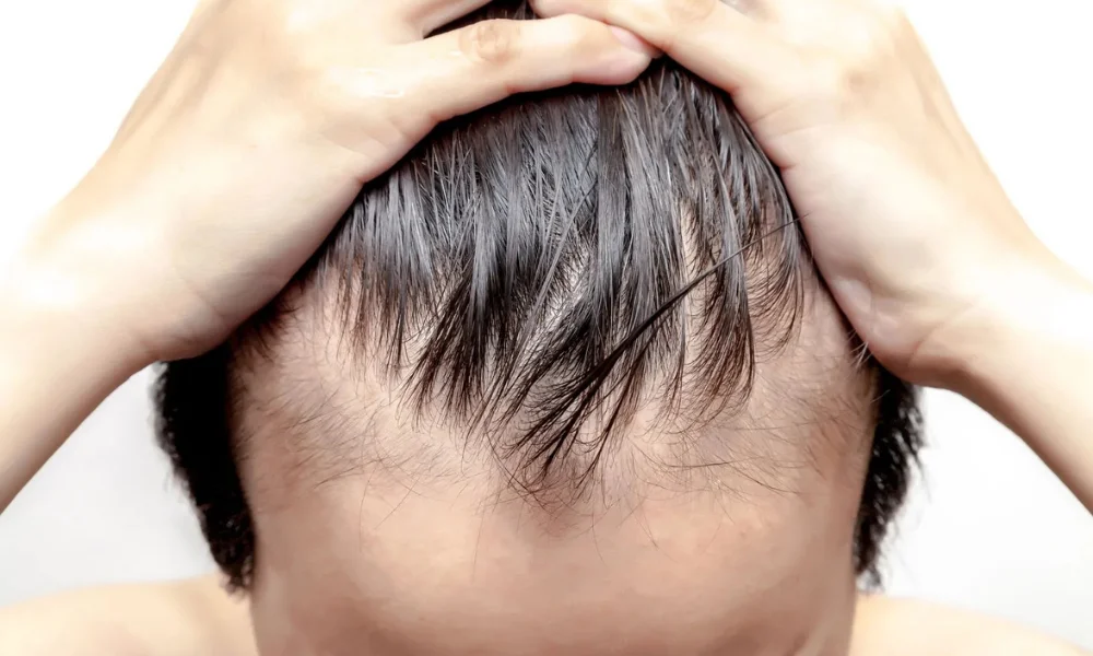 Hair Loss Age Differences Men vs Women