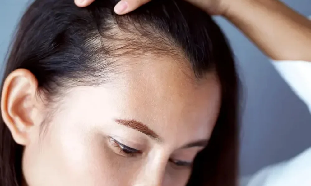 Hormonal Effects on Baldness
