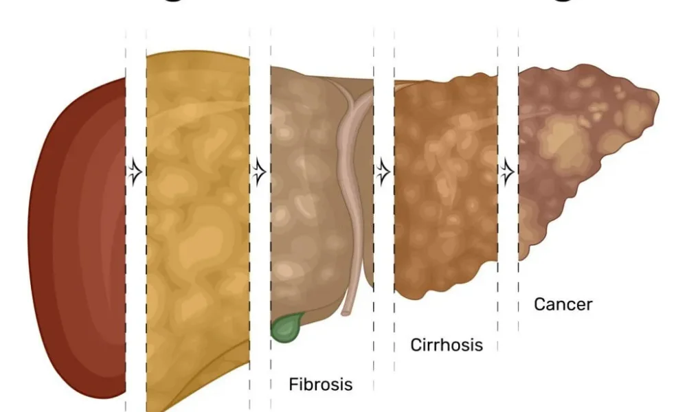 Fatty Liver Reversal: Dr. Chokkalingam Tips