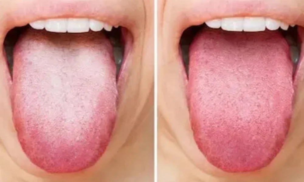 What Your Tongue Color Reveals About Your Health