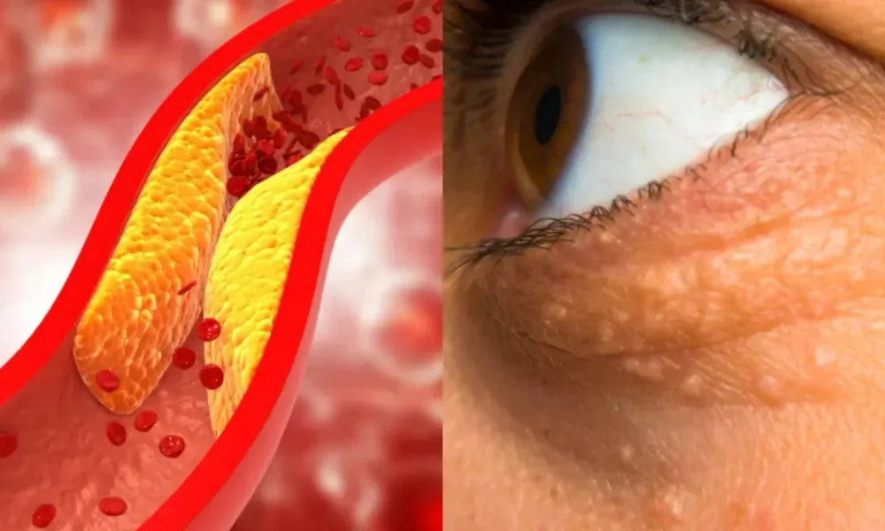High Cholesterol Symptoms