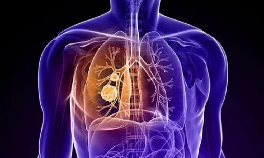 Lung cancer myths and facts 2025