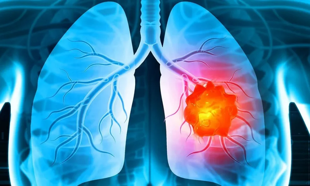 Lung cancer in young adults 2025