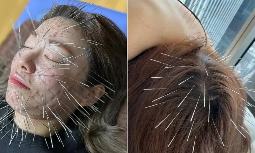 Shirakawa Acupuncture Craze 2025