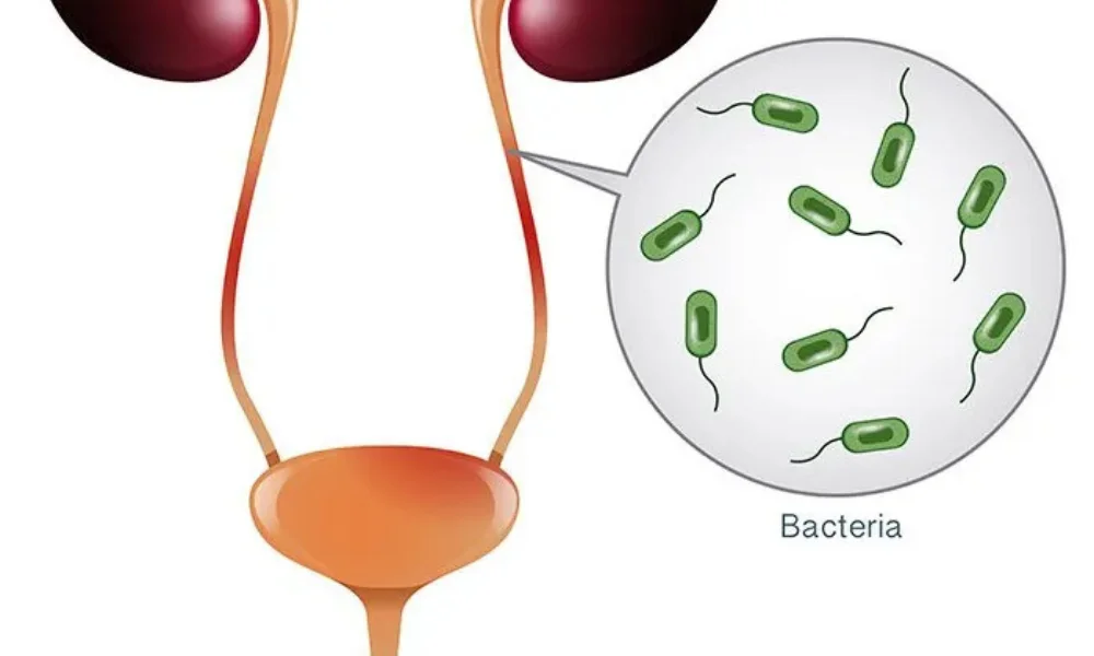 UTI foods to avoid during treatment