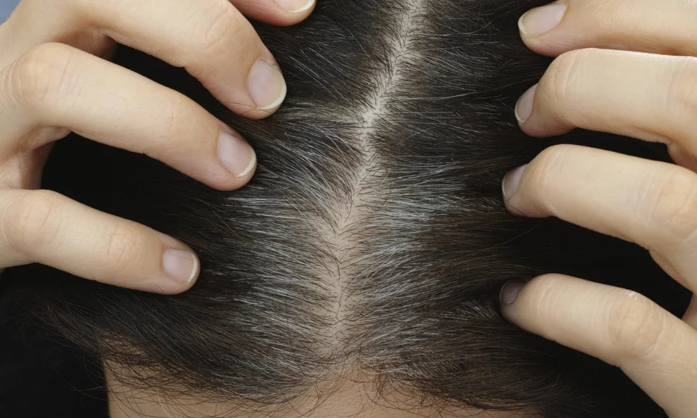 Vitamin Deficiencies Causing Premature Gray Hair