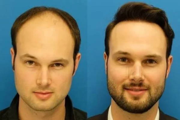 Image of: Fair and Hair Wig Hair Fixing Hair Weaving Tirunelveli