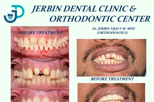 Image of: Jerbin Dental Clinic Ganapathipuram Tamil Nadu Orthodontics