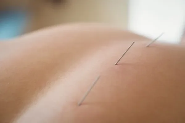 Image of: Needles Acupuncture Clinic for Pain Relief and Wellness