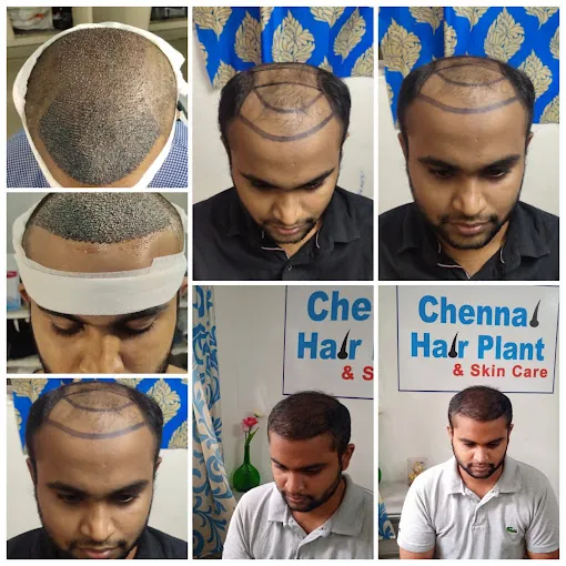 Image of: Hair Plant And Skin Care In Chennai