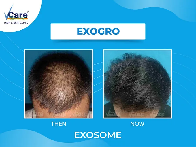 Image of: Vcare Hair And Skin Clinic In Anna Nagar