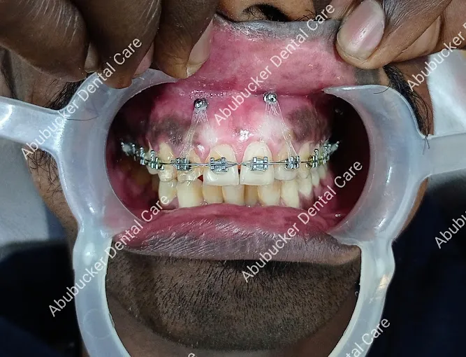 Image of: Abubucker Dental Care And Orthodontic In Triplicane 5