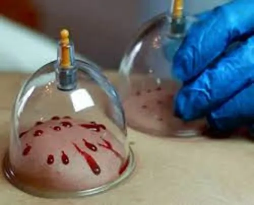 Image of: An Noor Varma Acupuncture Hijama In Perambur