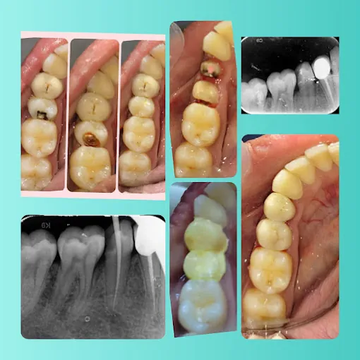 Image of: Bunny Teeth Advanced Dentistry In T Nagar