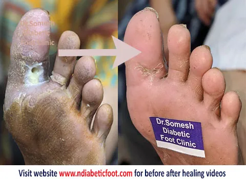 Image of: Dr Somesh Diabetic Foot Clinic In Otteri