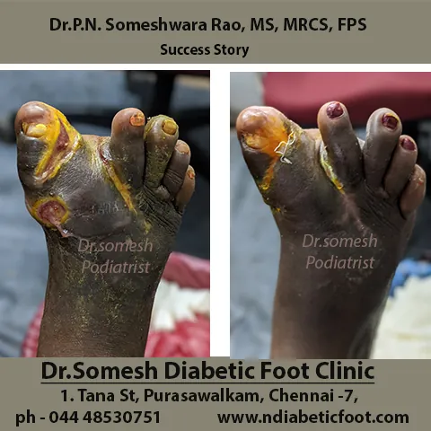 Image of: Dr Somesh Diabetic Foot Clinic In Otteri