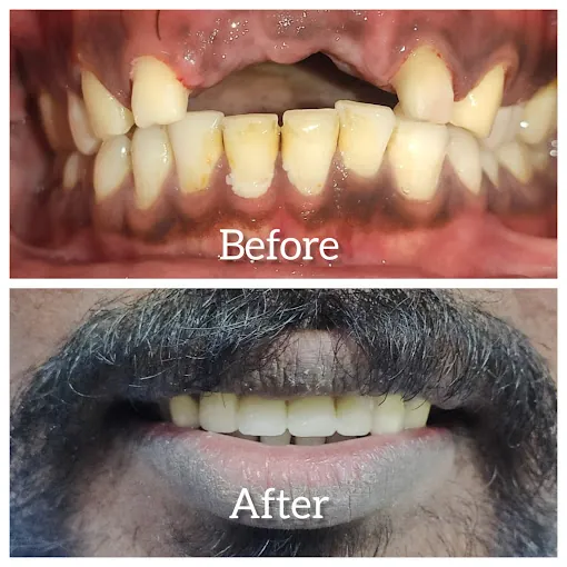 Image of: Gums And Roots Laser In Chennai