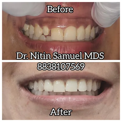 Image of: Gums And Roots Laser In Chennai
