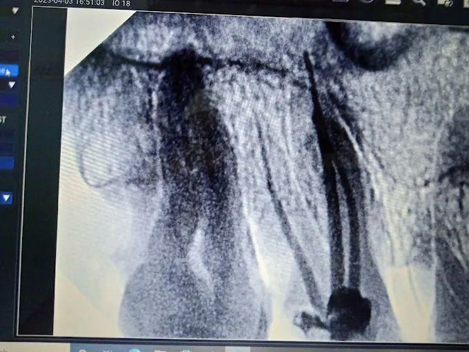 Image of: Mohammed Dental Care Implant Centre In Ayanavaram