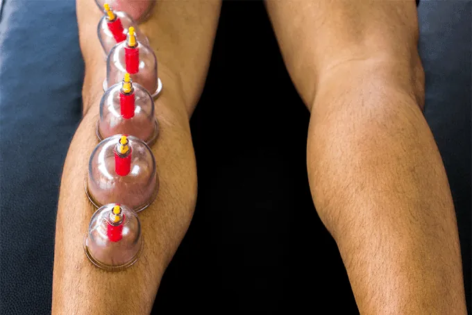 Image of: Mustafa Cupping Clinic In Arumbakkam